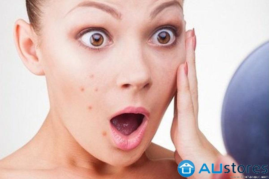 Bị dị ứng kem chống nắng các nàng phải làm sao?