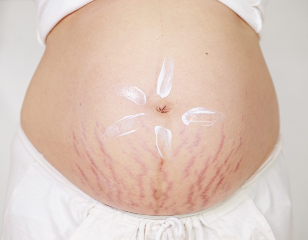 Cách ngăn ngừa và điều trị rạn da khi mang thai các mẹ bầu cần biết