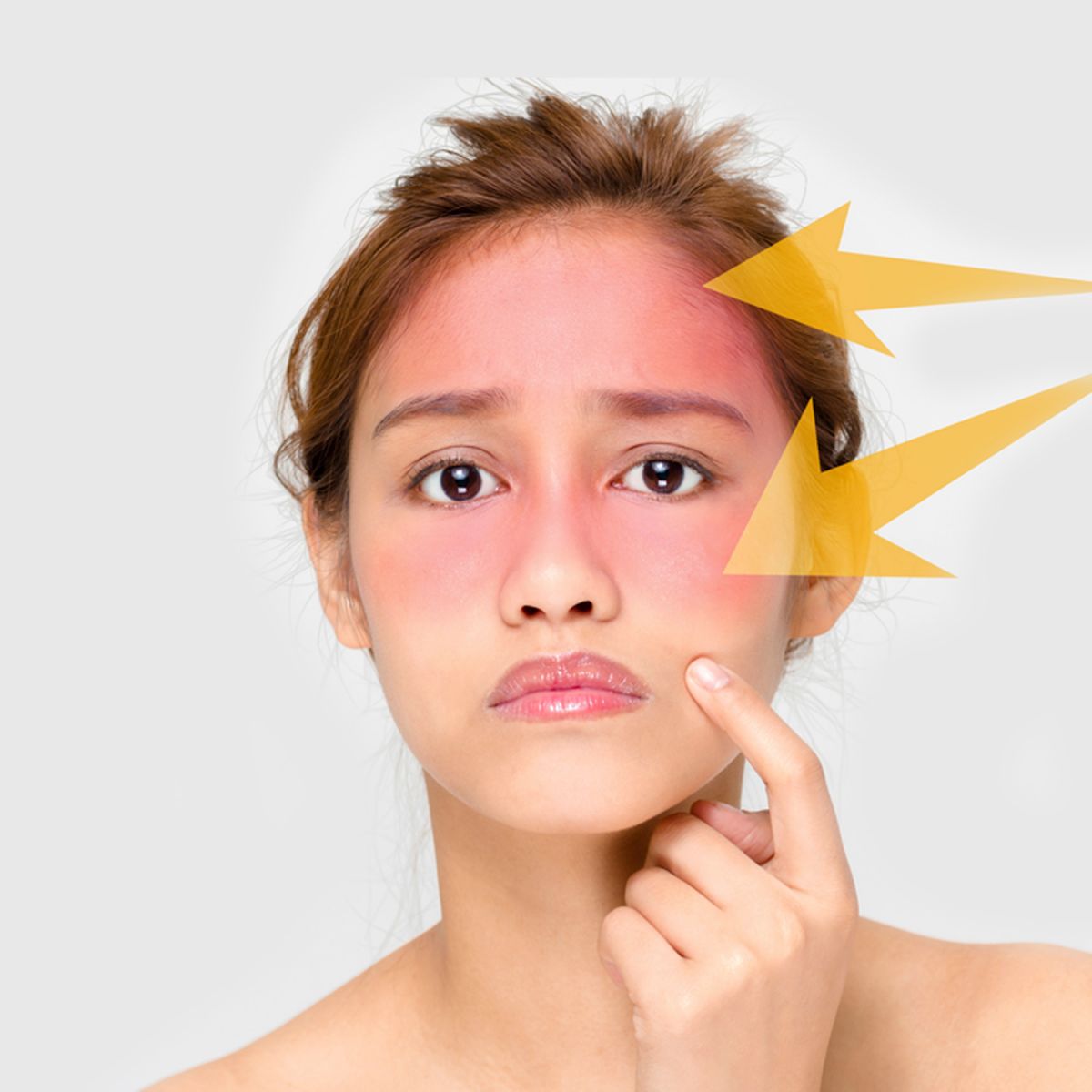 Bị dị ứng kem chống nắng các nàng phải làm sao?